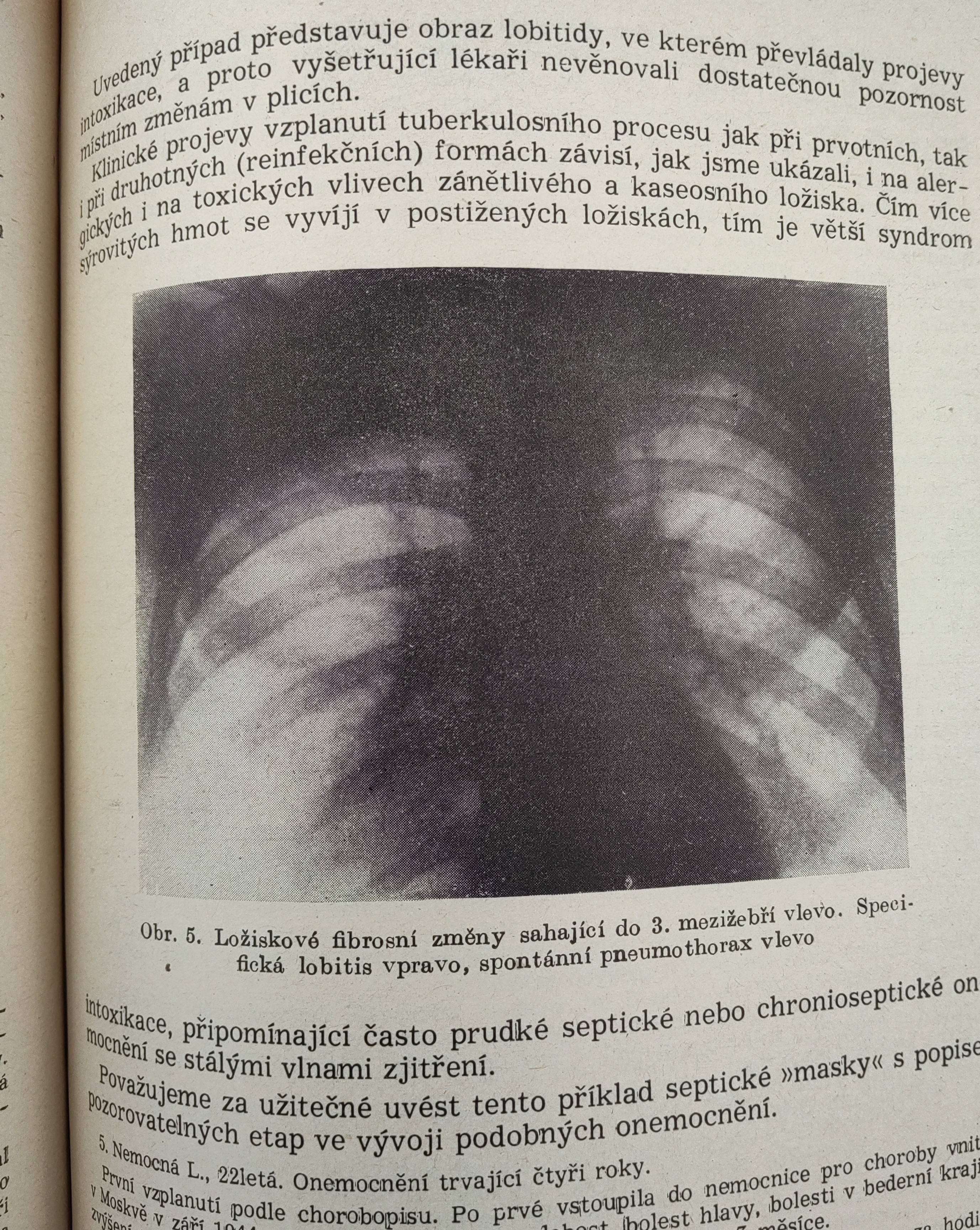 Časná diagnostika plicní tuberkulosy